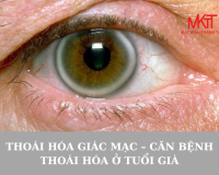 THOÁI HÓA GIÁC MẠC CĂN BỆNH THOÁI HÓA Ở TUỔI GIÀ